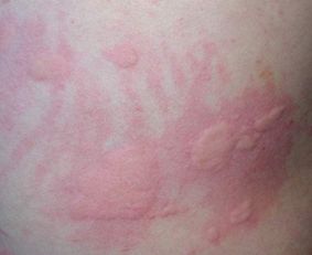 荨麻疹的那些事儿：一个真实患者的自我救赎