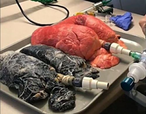 男子上香被烟呛后查出肺癌：一个家庭的悲剧与警示