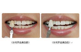 一口黄牙毁所有！等离子牙齿美白黑科技，45分钟逆袭妈生白！