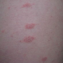 初识玫瑰糠疹：从饮食到护理的全方位解析