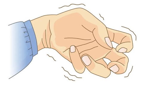 帕金森：别让手抖掩盖了病情恶化的真相