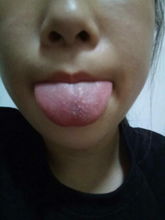 嘴巴像被开水烫了？查不出原因的口腔“隐形火灾”