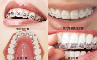 牙齿安装好了！我的真实体验与郑州种植牙医院排名揭秘