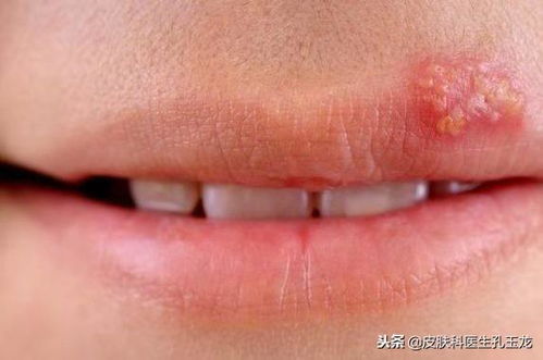 女子使用话筒后感染单纯疱疹病毒，背后真相令人担忧