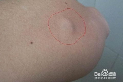 皮下脂肪褐变的秘密：修复皮肤的全新视角