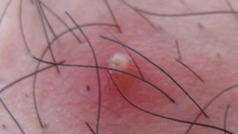 毛囊炎：皮肤上的“小火山”，真相与应对全攻略