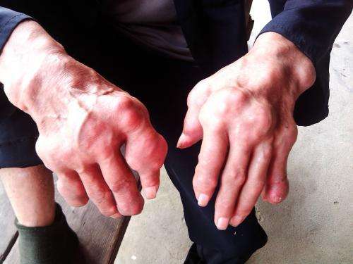 25岁小伙痛风12年四肢严重变形：一场被忽视的健康危机