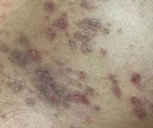 皮肤瘙痒、发黄还有蜘蛛痣？可能是肝脏在求救！