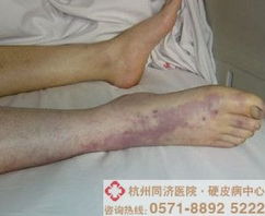 硬皮病患者长期服药无效？原来是它在作怪！