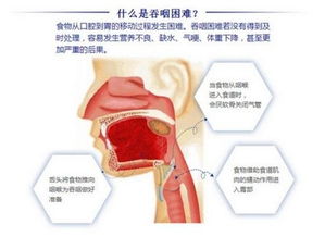 吞咽困难、呛咳卡痰的渐冻症患者注意了，这五种食物助你喉咙通顺！