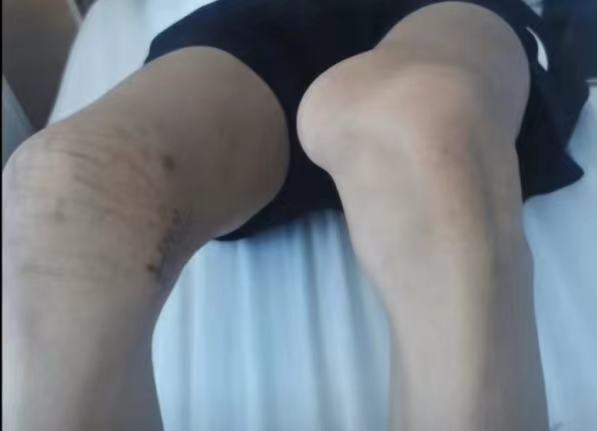 体育生被错切右膝：医疗纠纷案即将开庭，真相如何？