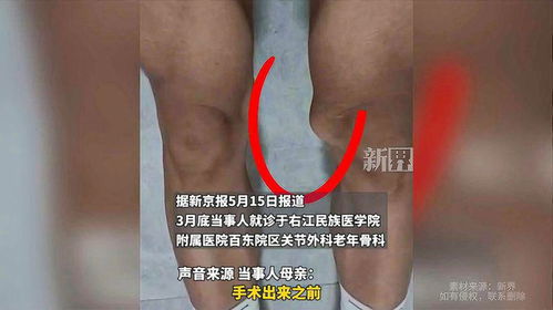 体育生右膝被错切：母亲坚持不和解，医疗纠纷案如何走向？