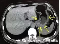 CT扫描真的会增加癌症风险？真相在这里！