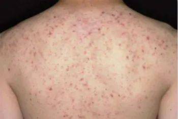 关于毛囊炎，这些知识你要知道