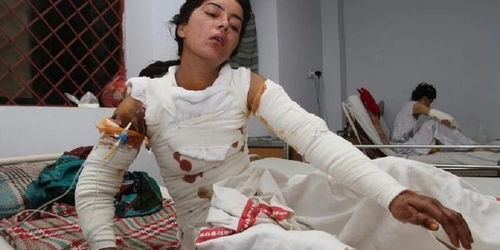 被前男友泼汽油烧伤的女孩：我的新生之路