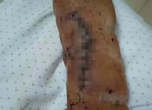 男粉丝咬伤女主播后留下纸条：赔十万元还是十5元？