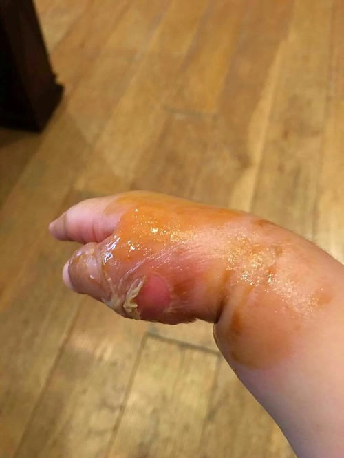 员工冲奶粉烫伤算工伤？公司起诉被驳回，法院为何这样判？