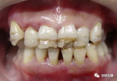 女子花6万做种植牙结果牙全没了，背后真相令人震惊