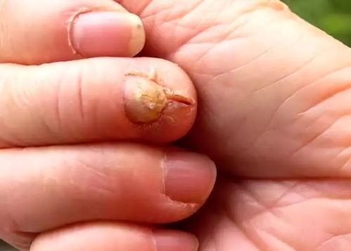 女子晒得类风湿16年的手与脚：阳光下的代价