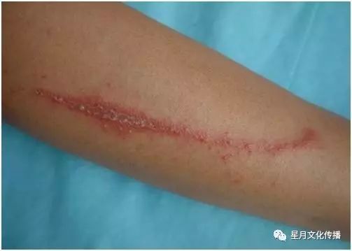 隐翅虫咬伤后的手臂