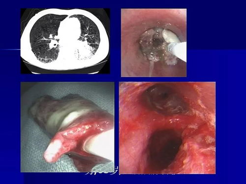 70岁大爷一口烂牙引发肺部空洞：口腔健康的重要性被忽视了太久