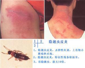 隐翅虫科普宣传