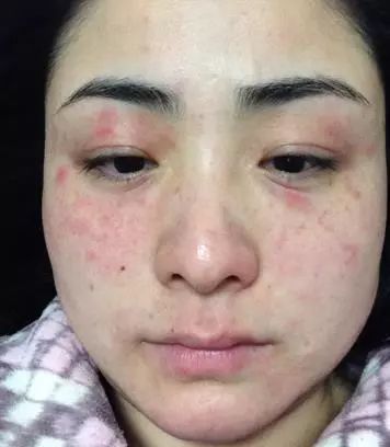 皮肤过敏症状