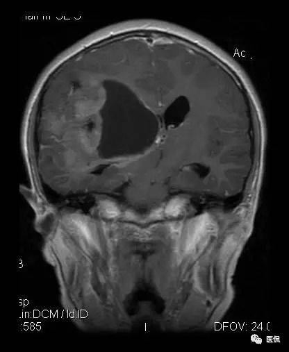 胶质母细胞瘤显微图像