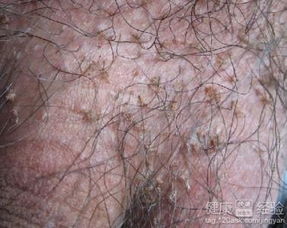 显微镜下的肝吸虫虫卵