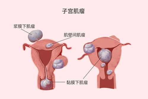 子宫肌瘤常见于女性子宫部位示意图