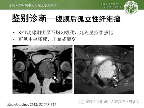 腹膜后平滑肌瘤病理示意图
