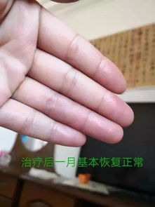 医生为患者检查手部血管瘤