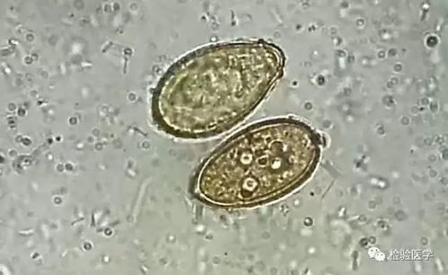 男子吃鱼生致胆管被肝吸虫堵住｜60岁财叔体内取出20多条寄生虫，你还敢贪嘴吗？