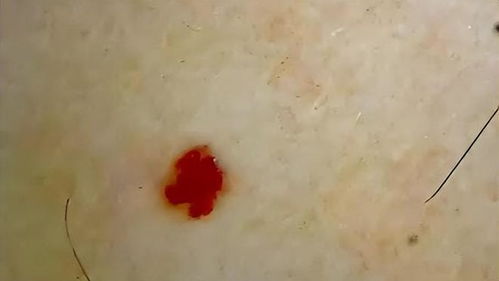 女生晒手电筒照意外发现血管瘤，网友提醒救了一命？