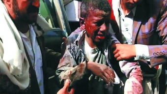 一名受伤的也门儿童在医院接受治疗