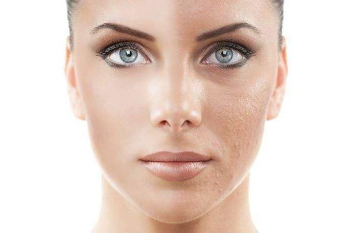 医生正在为患者进行果酸换肤治疗