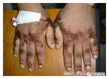 3岁女童突发急性铊中毒，医生紧急解读：家长必看的防护指南