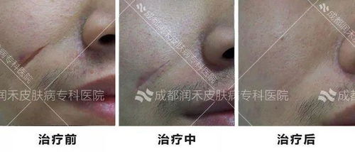 疤痕修复前后对比图示例