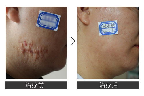 疤痕自然淡化的案例照片