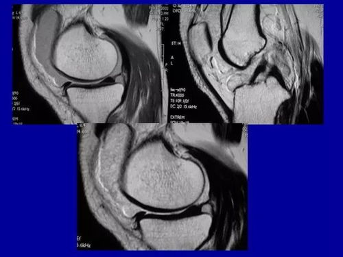 RA患者滑膜组织显微图像