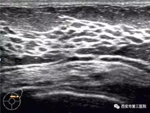 乳腺超声检查示意图