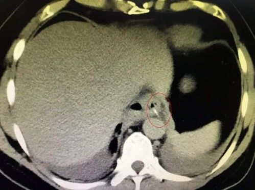 男子误吞5cm鱼刺用土方后呕血身亡！这些“民间偏方”真的害人不浅