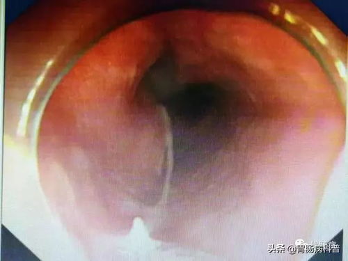 医生通过胃镜取出鱼刺