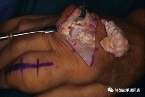 痛风石手术前后对比