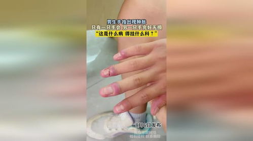 男子旅游误碰霍麻草手迅速红肿，这些植物千万小心！