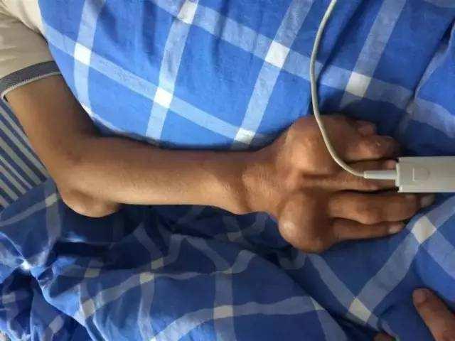 男子双手长满痛风石无法工作：年轻小伙的健康警钟