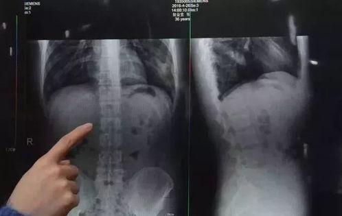 医院X光片显示胃部有异物影像