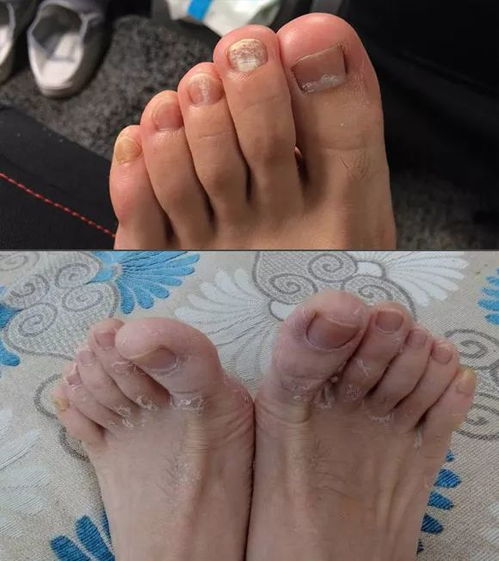 脚部有脚气的特写