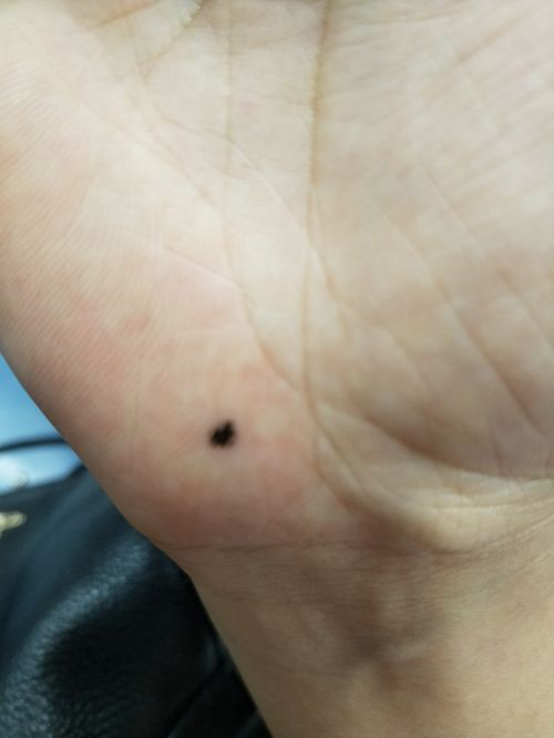 刷到就是提醒！这颗 “厄运痣” 不除，一辈子被霉运缠身！