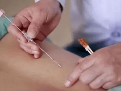 针灸穴位埋线治疗示意图